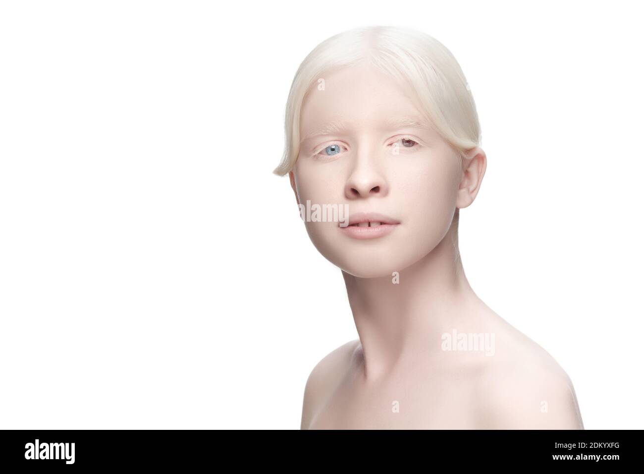 Beautiful albino woman with heterochromia isolated on white studio background. Copyspace for ad. Concept of beauty, fashion, healthcare, skincare. Complete special eyes colour, blue and brown. Stock Photo