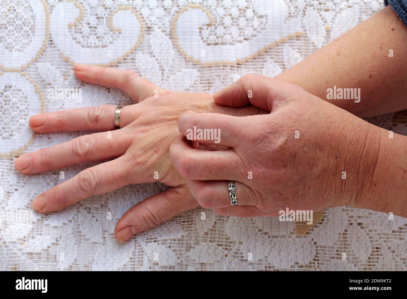 Itching reddened skin. A woman is scratching her arm. Allergic reaction. Skin disease Stock Photo