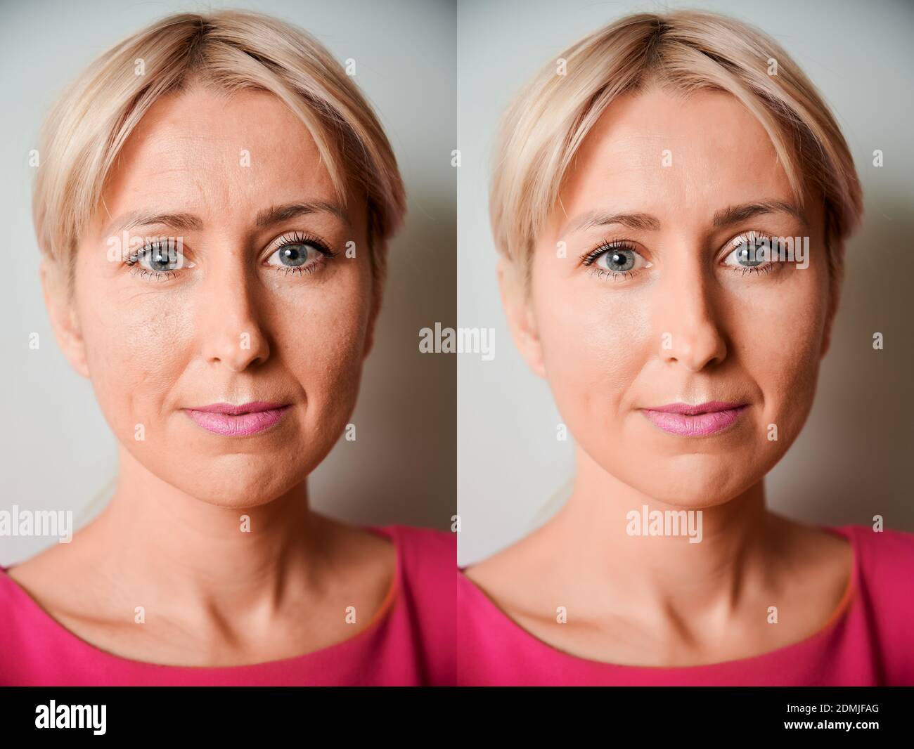 Set of two portraits of the same woman, one before and other after treatment Stock Photo