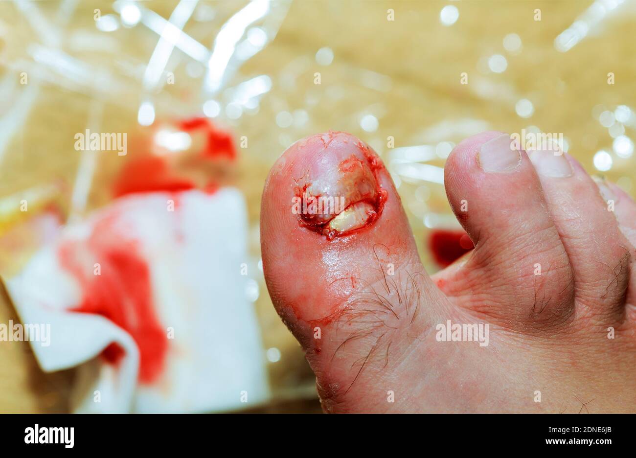 Fingernail Damage On Legs The Blood Is Torn Off The Nail Close Up Stock Photo Alamy
