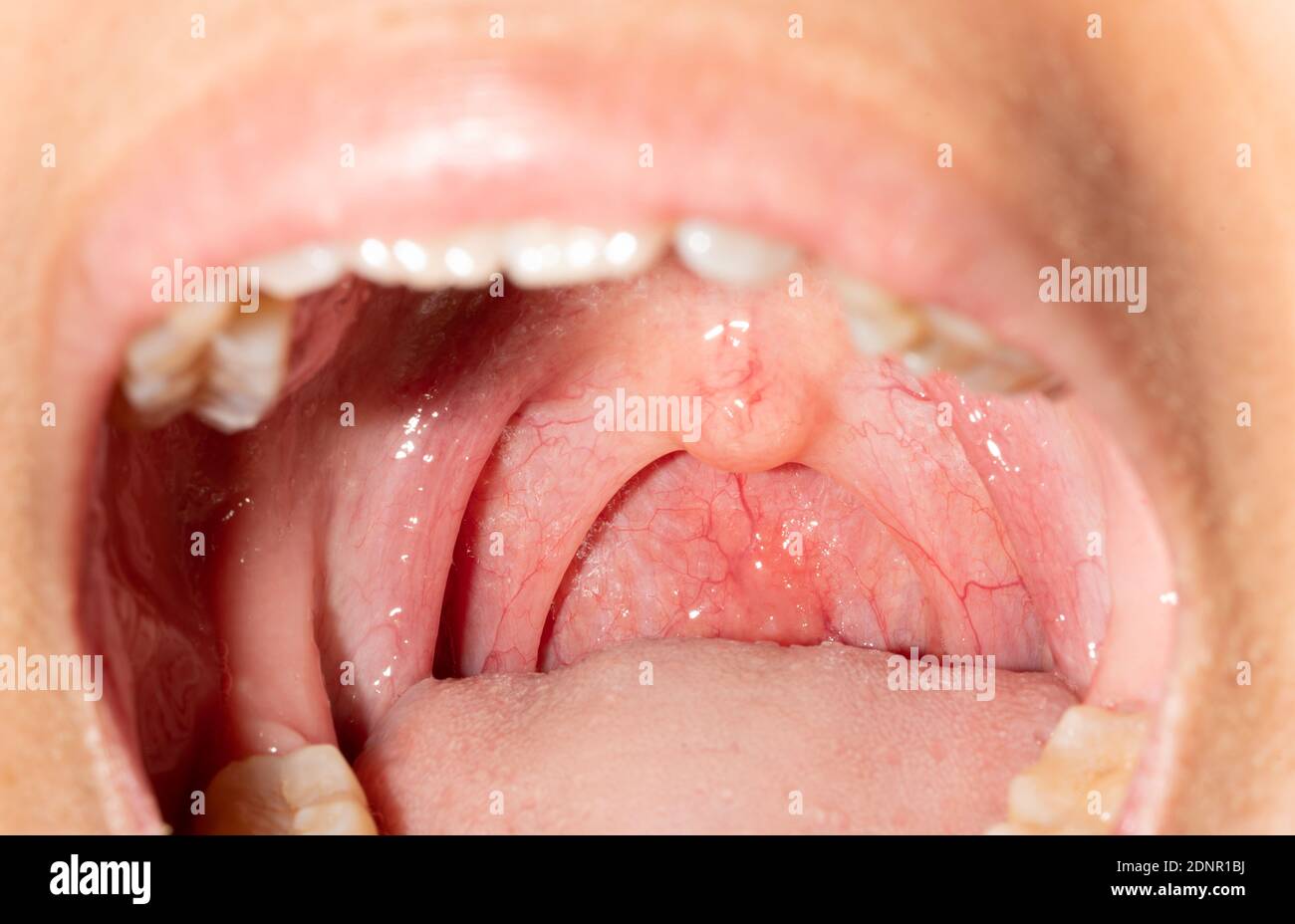 Bumps On Throat Wall