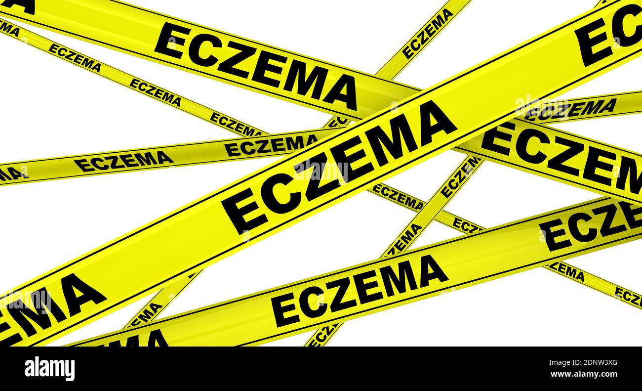 Skin diseases and eczema hires stock photography and images Alamy