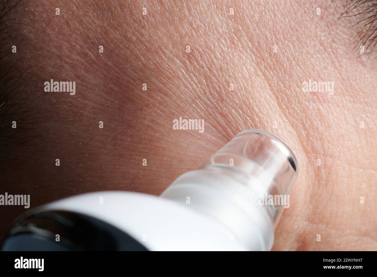 Cleaning skin  therapy  on forehead with suction tool macro close up view Stock Photo