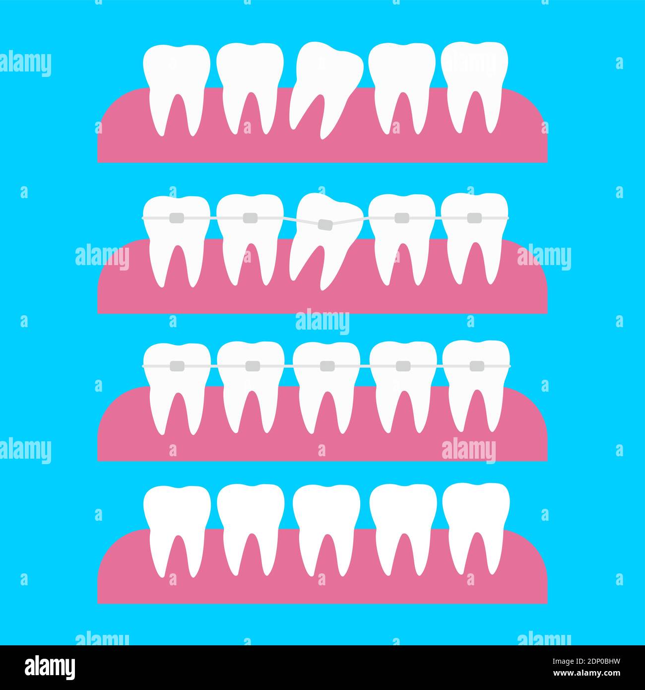 Correction of teeth with orthodontic braces. Tooth orthodontic