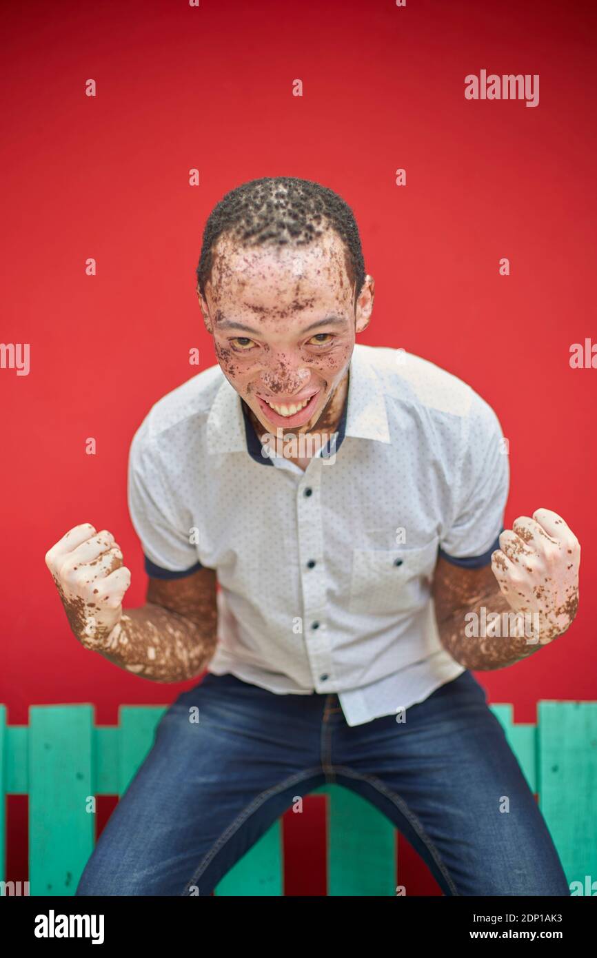 Young man with vitiligo on a green bench Stock Photo