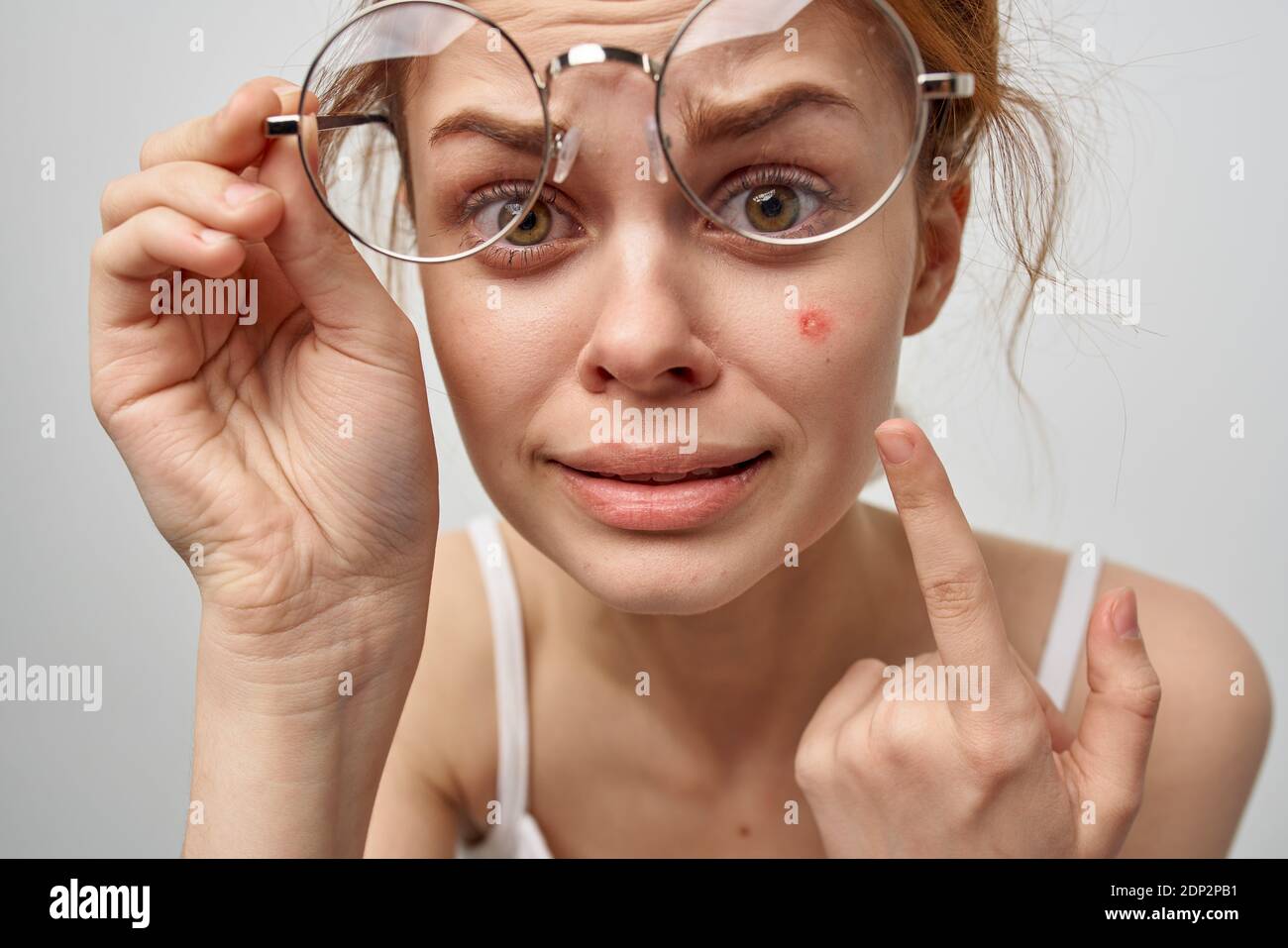 woman with glasses shows a finger to a red pimple on her face health