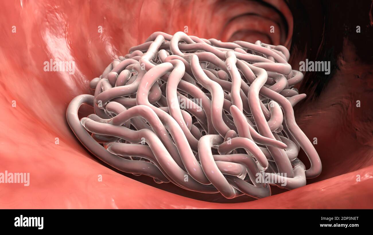 Round worms in human intestine, computer illustration. Roundworms, or ...
