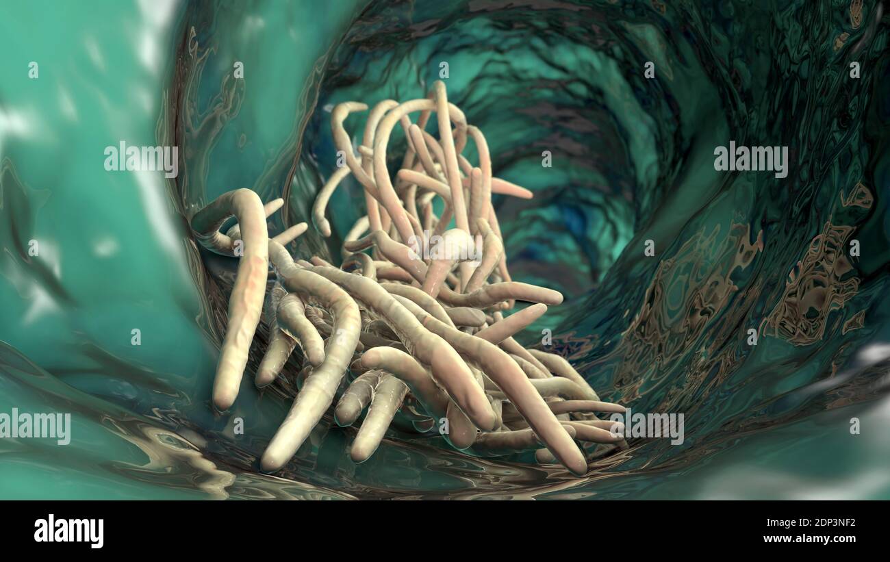 Round worms in human intestine, computer illustration. Roundworms, or