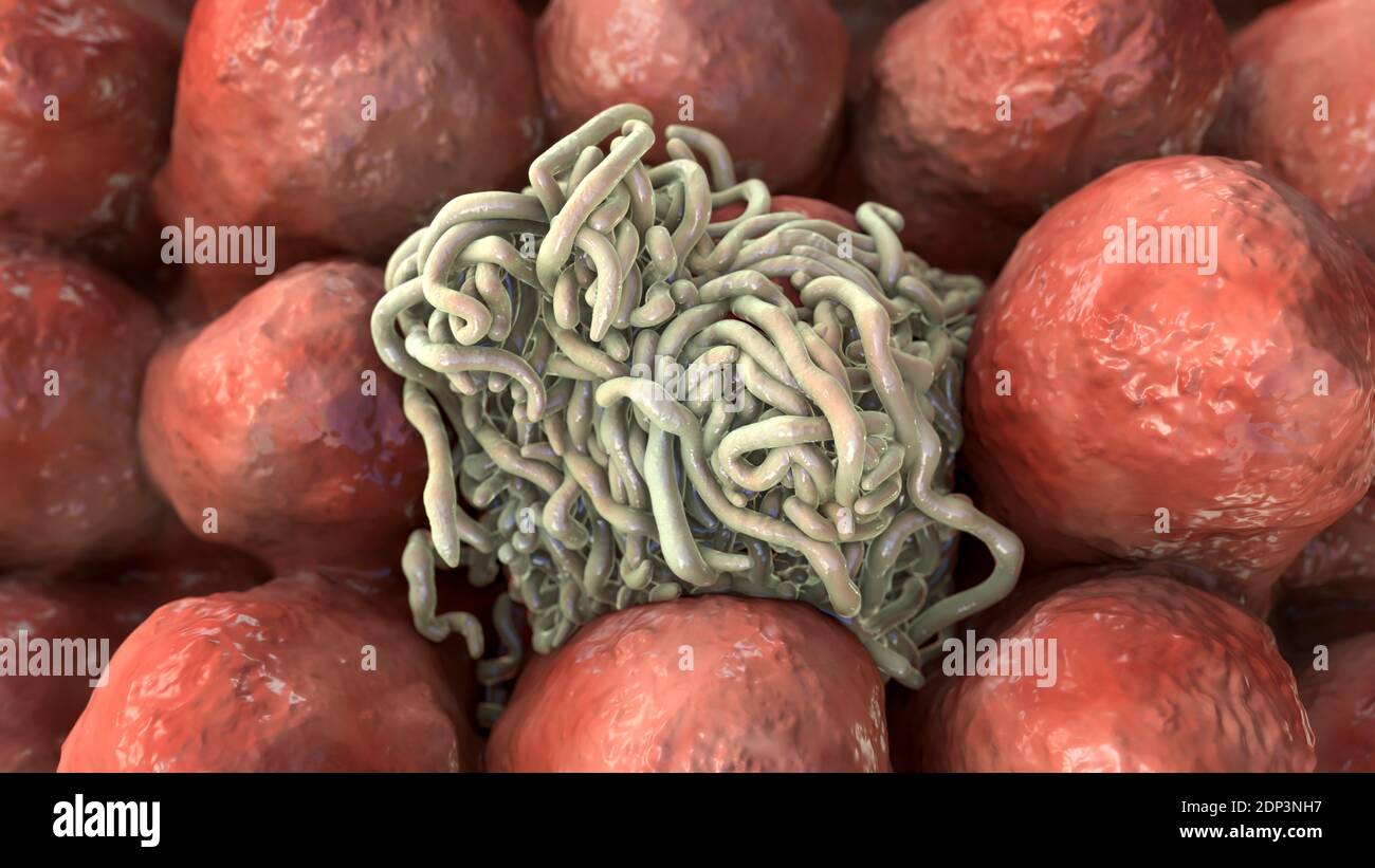 Round worms in human intestine, computer illustration. Roundworms, or