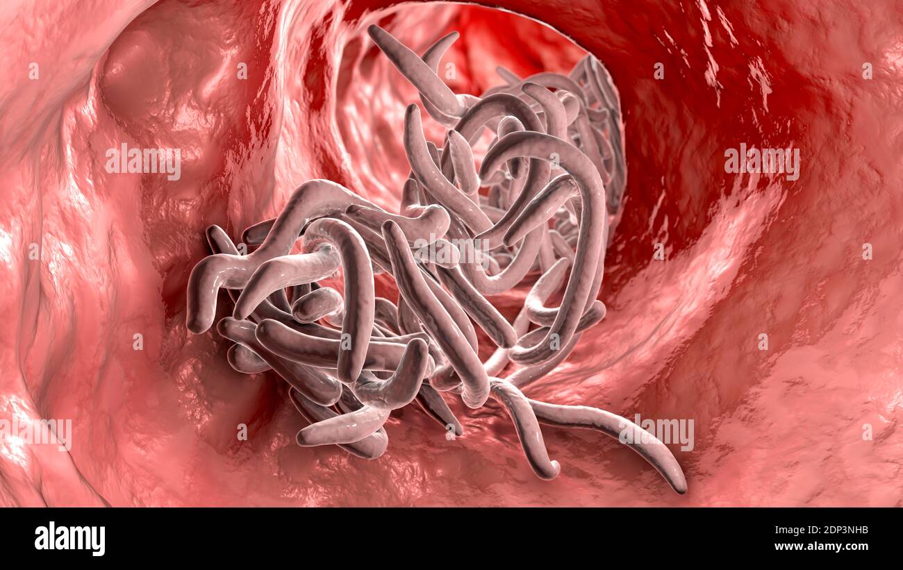 Round worms in human intestine, computer illustration. Roundworms, or