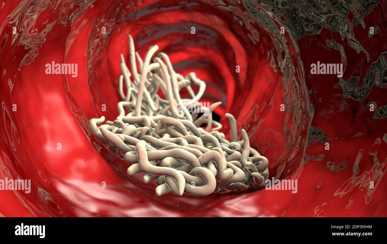 Round worms in human intestine, computer illustration. Roundworms, or nematodes, include