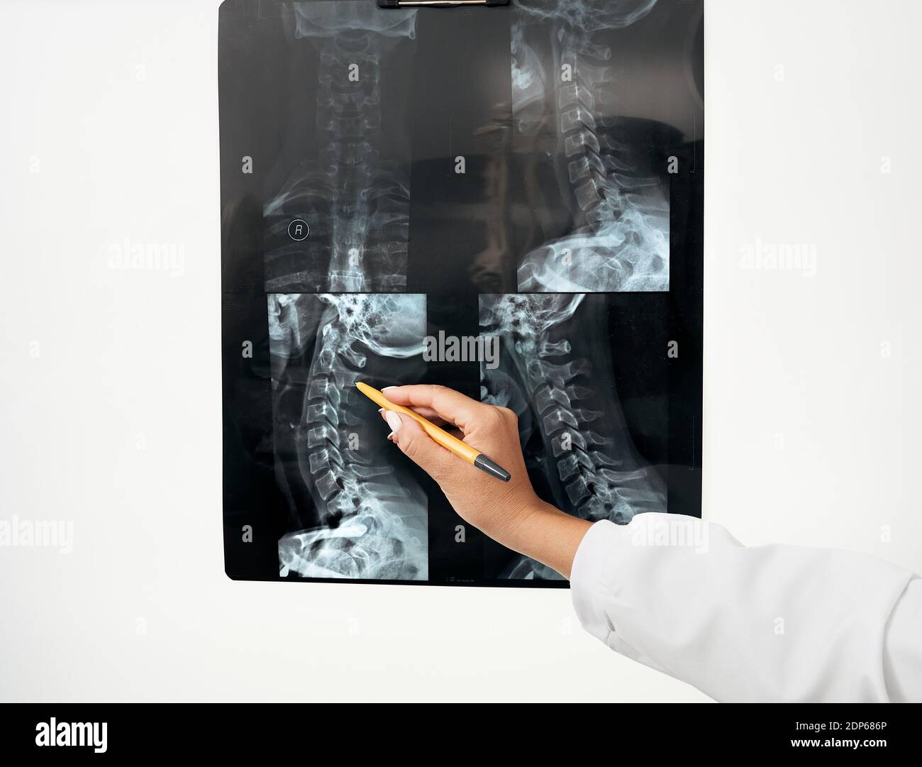doctor neurologist looks to x-ray image of the patient cervical spine using negatoscope. Treatment of spine disease, and osteochondrosis Stock Photo
