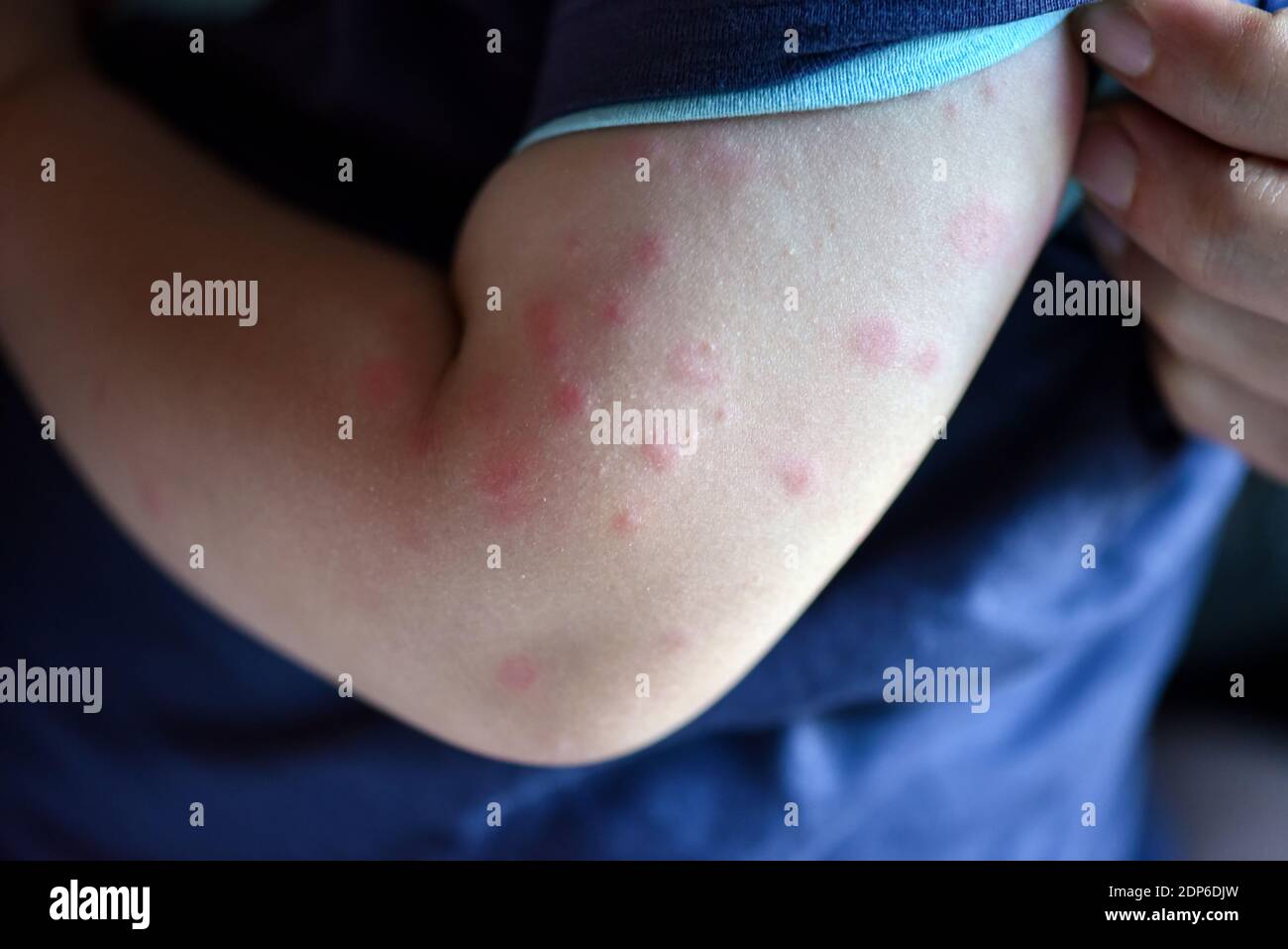Child with hives on his arm. Hives, also known as urticaria, is a kind of skin rash with red, raised, itchy bumps or spots. Stock Photo