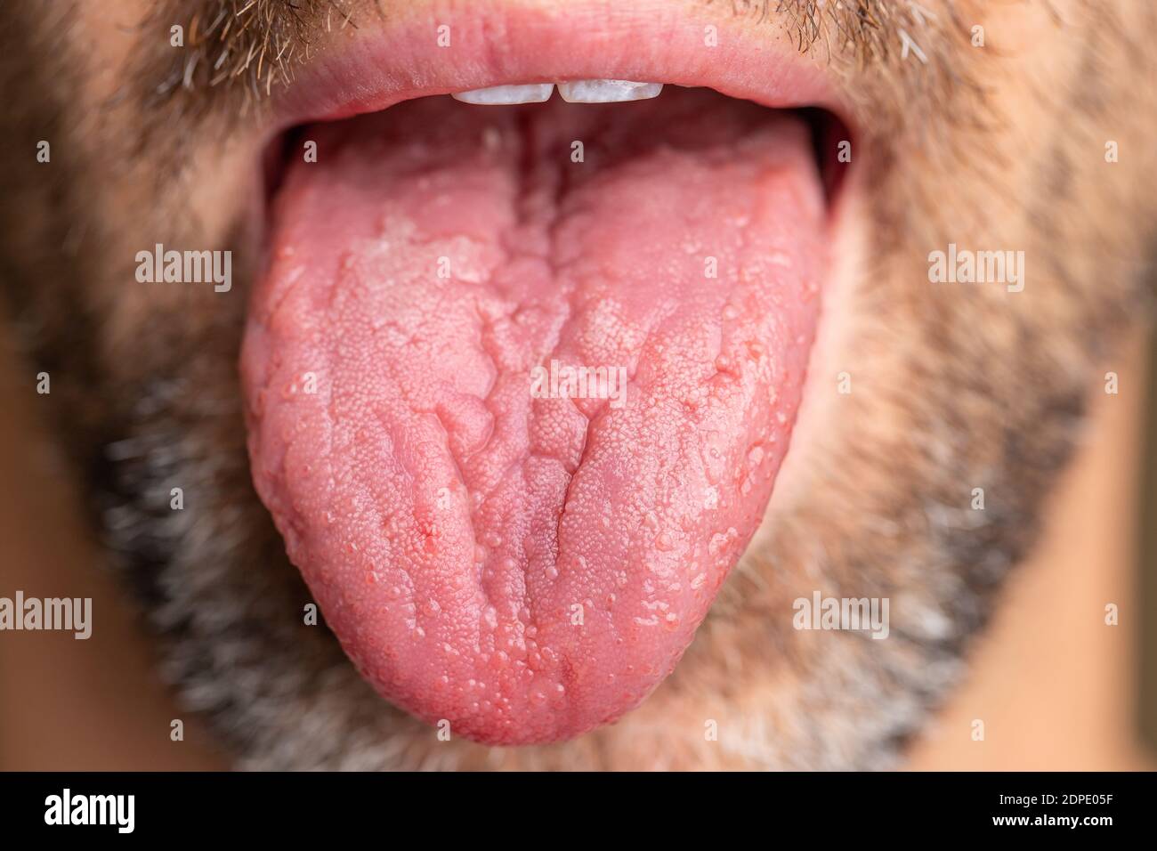A white male with brown and white facial hair. Tongue is sticking out to show geographic tongue, also known as benign migratory glossitis. Stock Photo