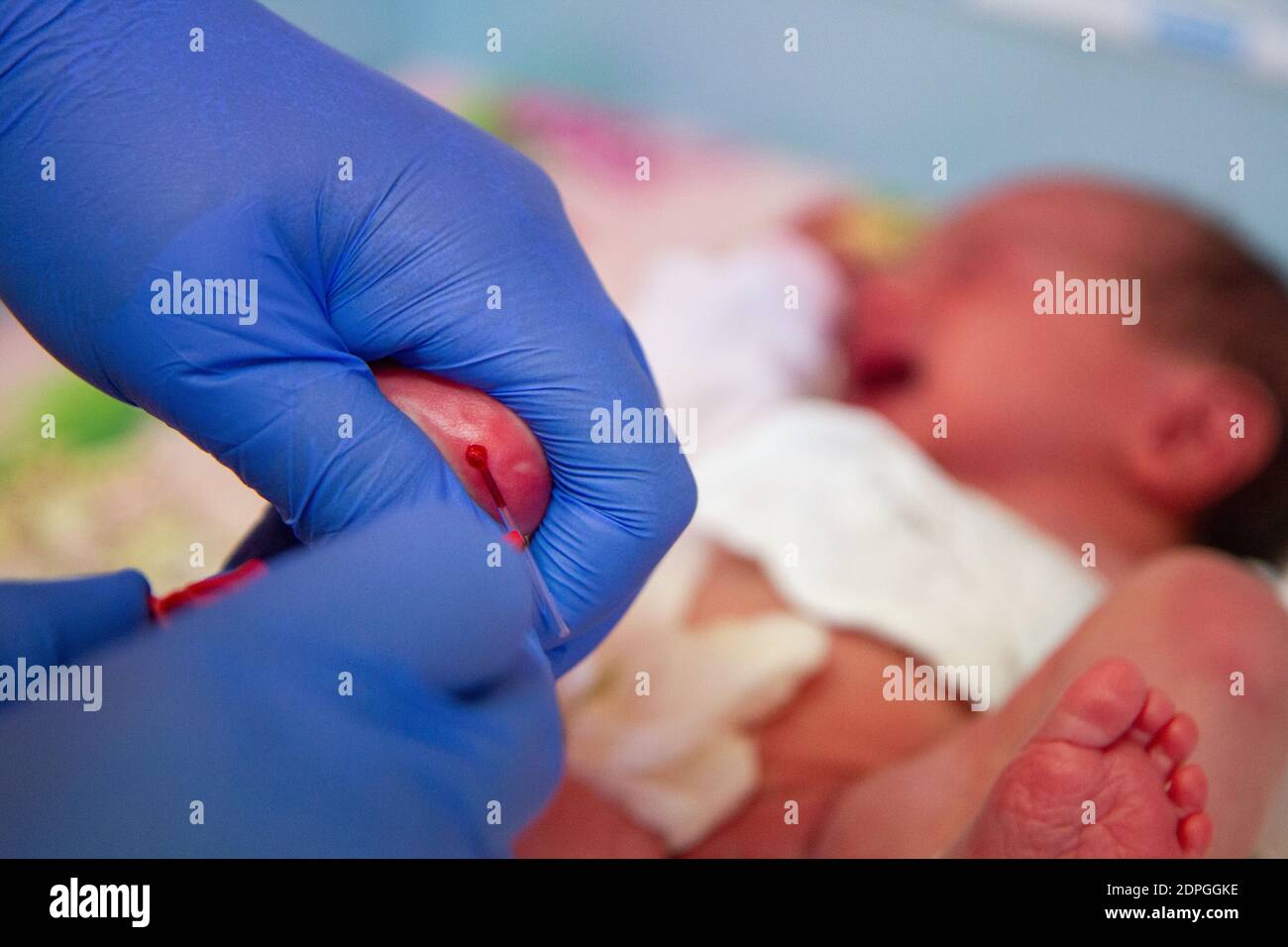 Neonatal Testing Newborn blood spot or heel prick test (the Guthrie test). A ...