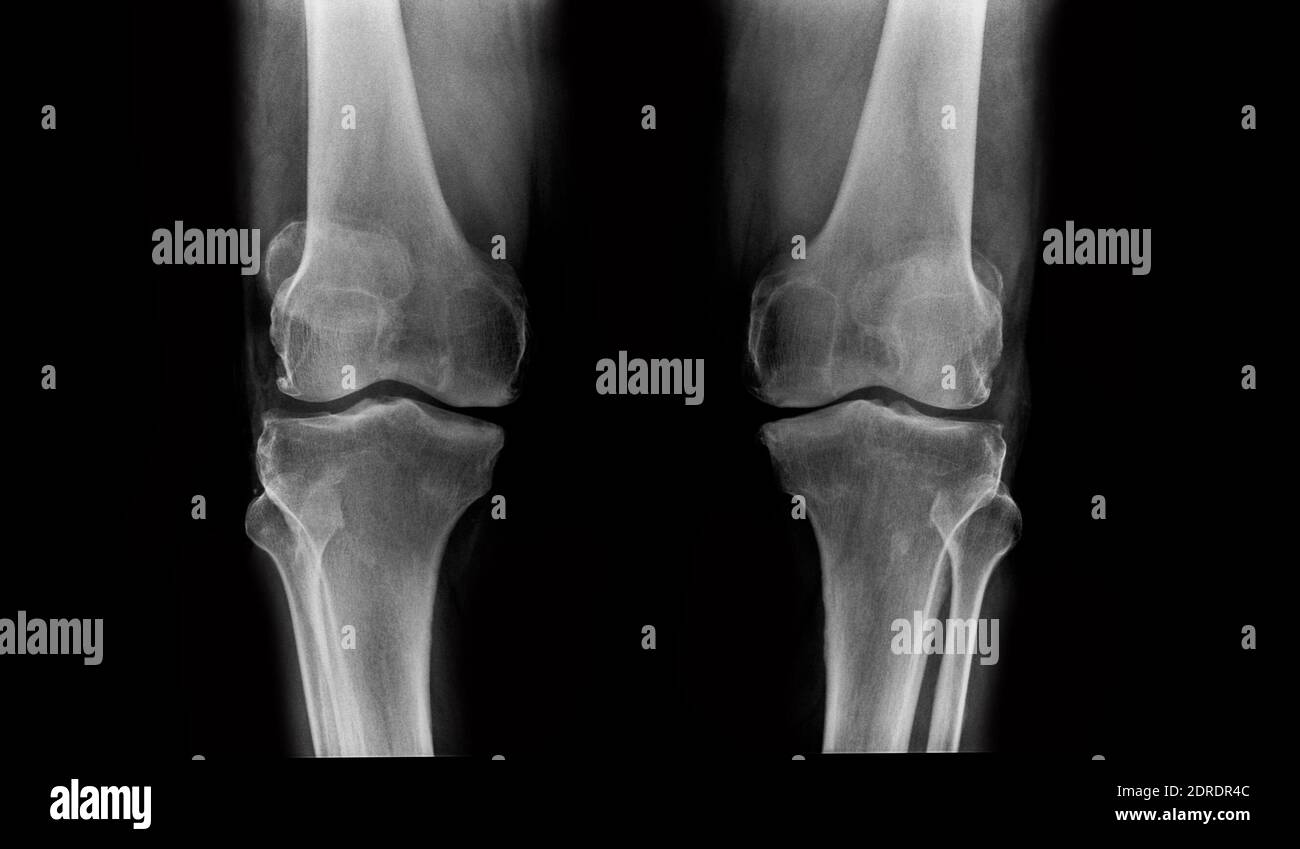 Full Body X Ray High Resolution Stock Photography and Images Alamy