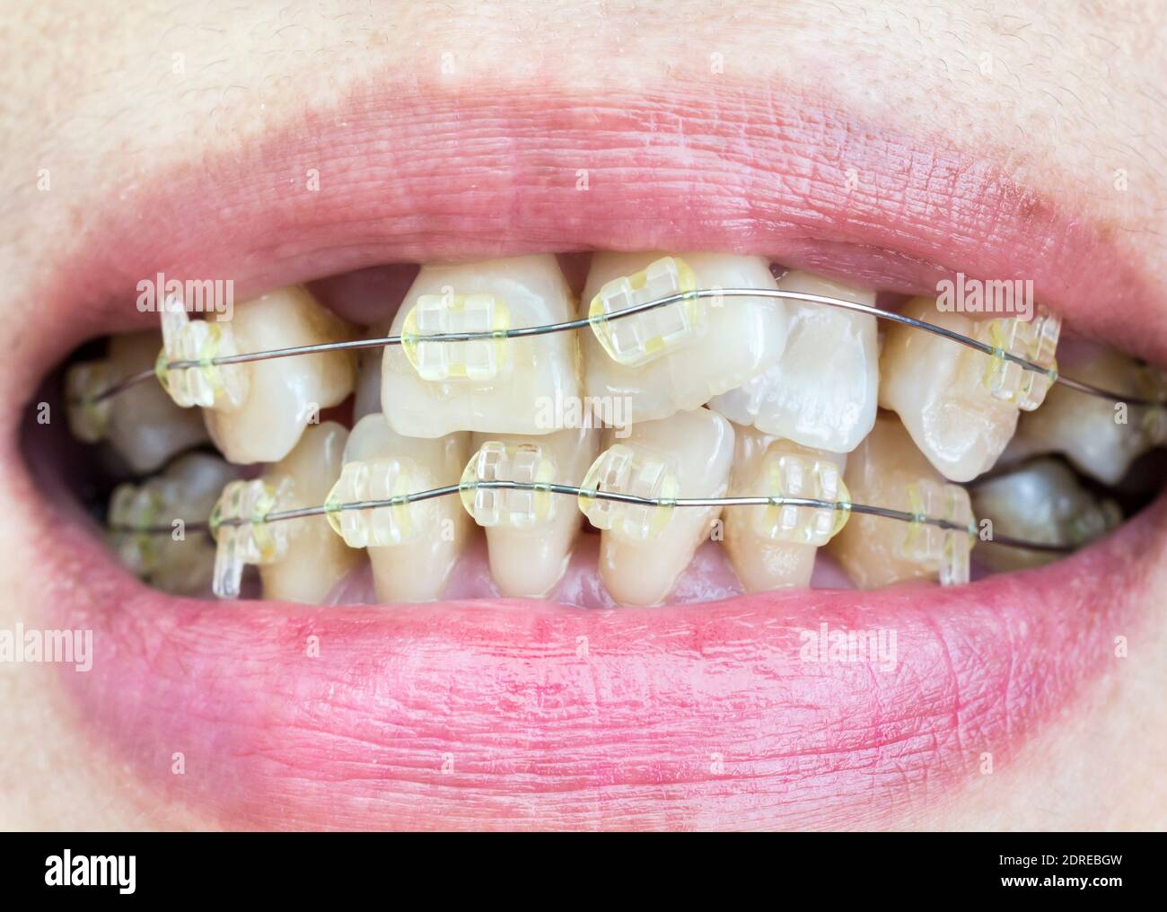 Closeup mouth of crooked teeth with braces Stock Photo Alamy