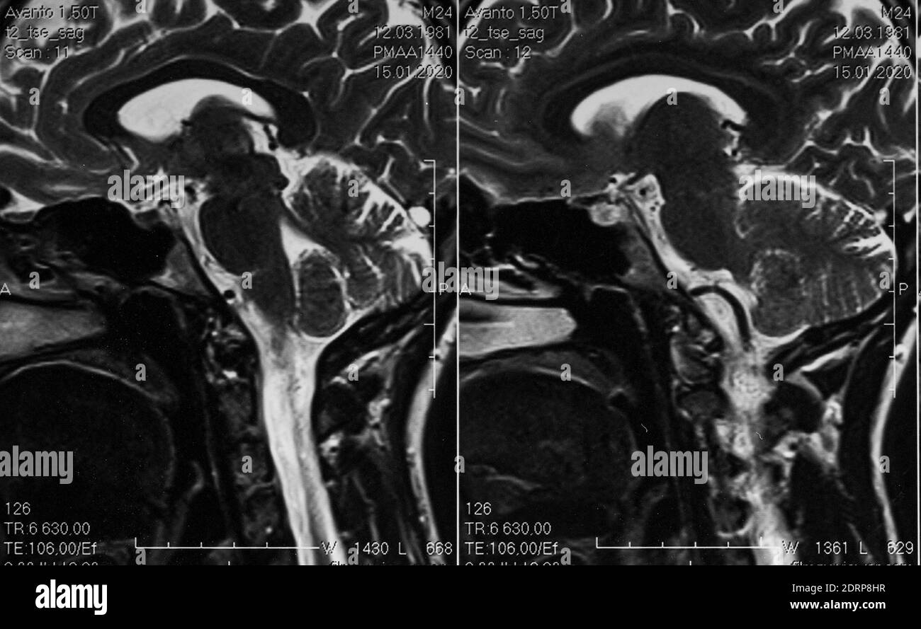 MRI scan of human brain, sagittal view, cerebellum Stock Photo