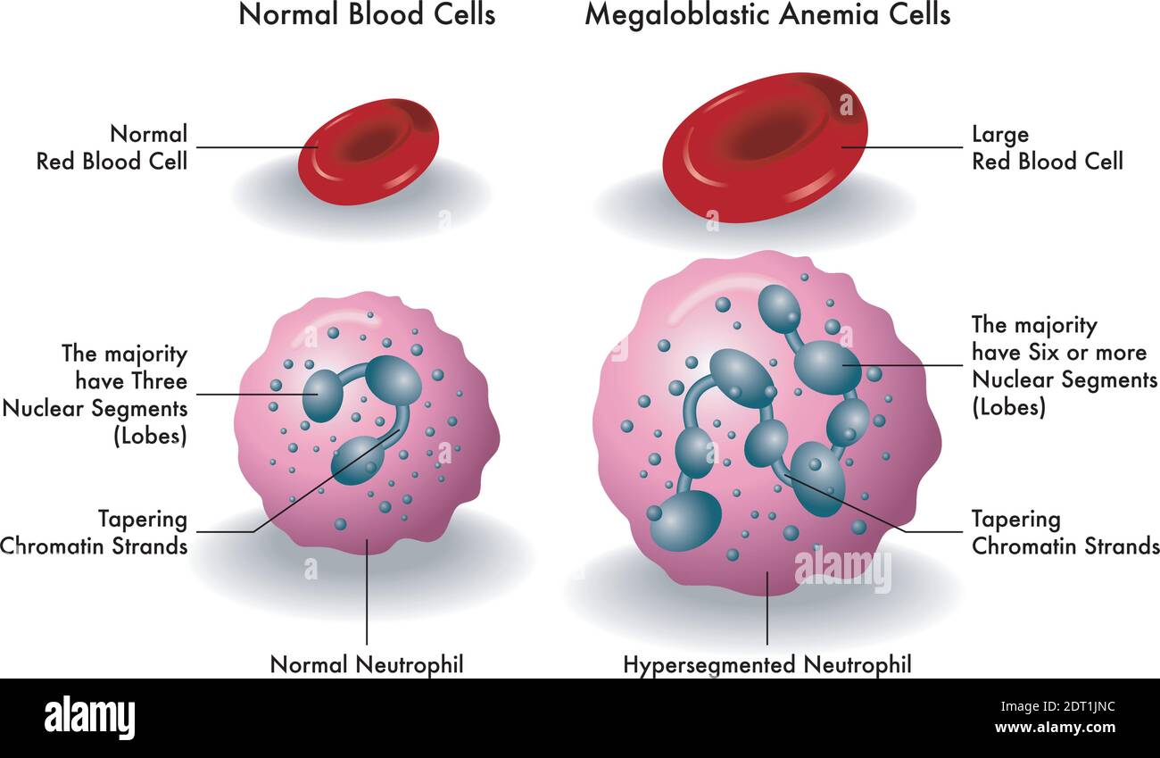 Medical illustration shows the difference between normal blood cells and megaloblastic anemia cells. Stock Vector