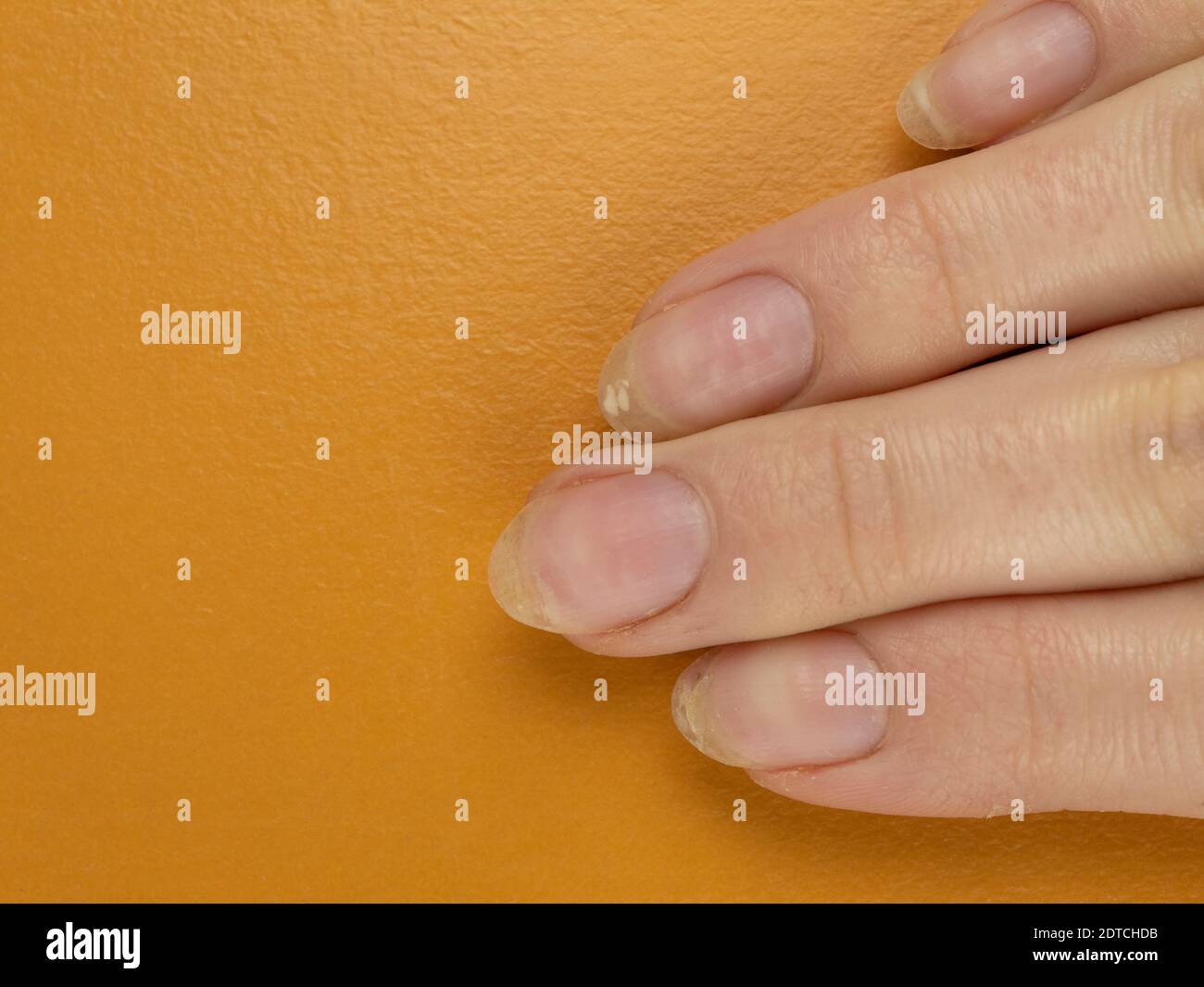 Fingers with sore nails that exfoliate. Onychorrhexis Stock Photo