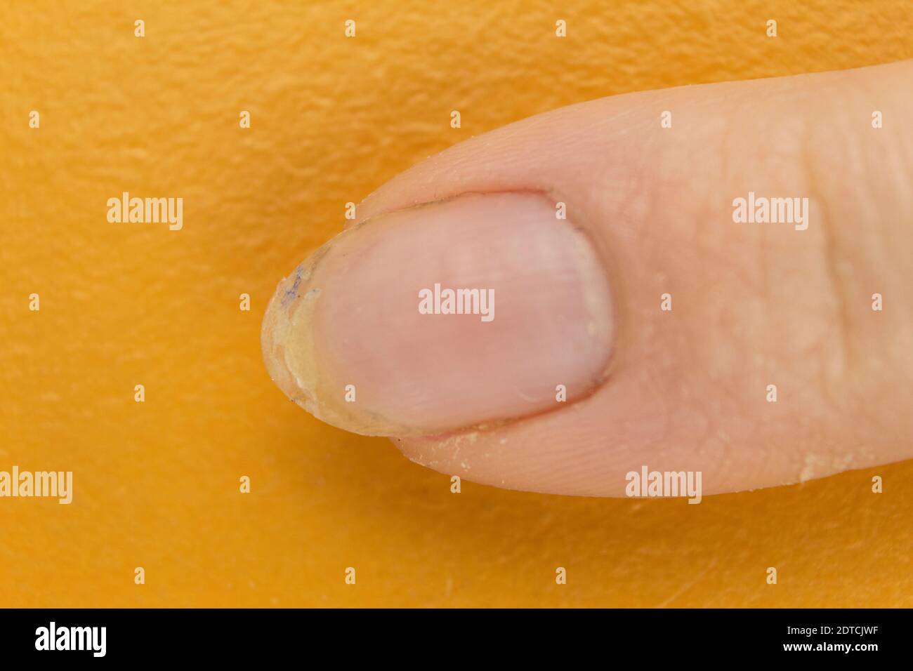 Nail Disease High Resolution Stock Photography And Images Alamy