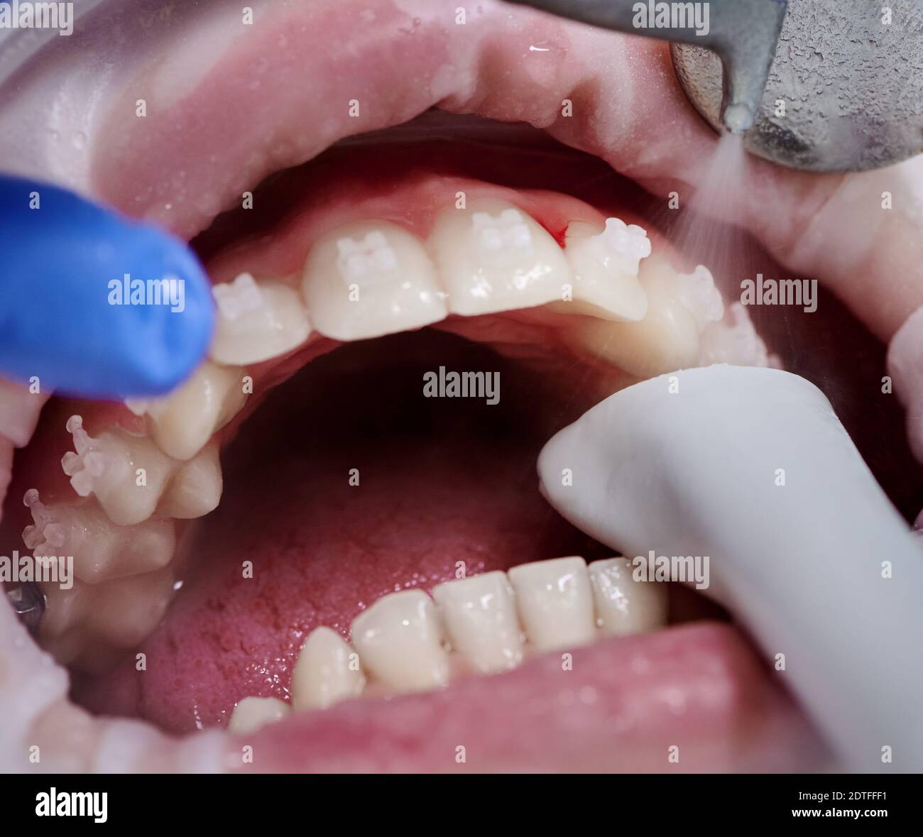 Close up of orthodontist using dental tools while cleaning teeth of