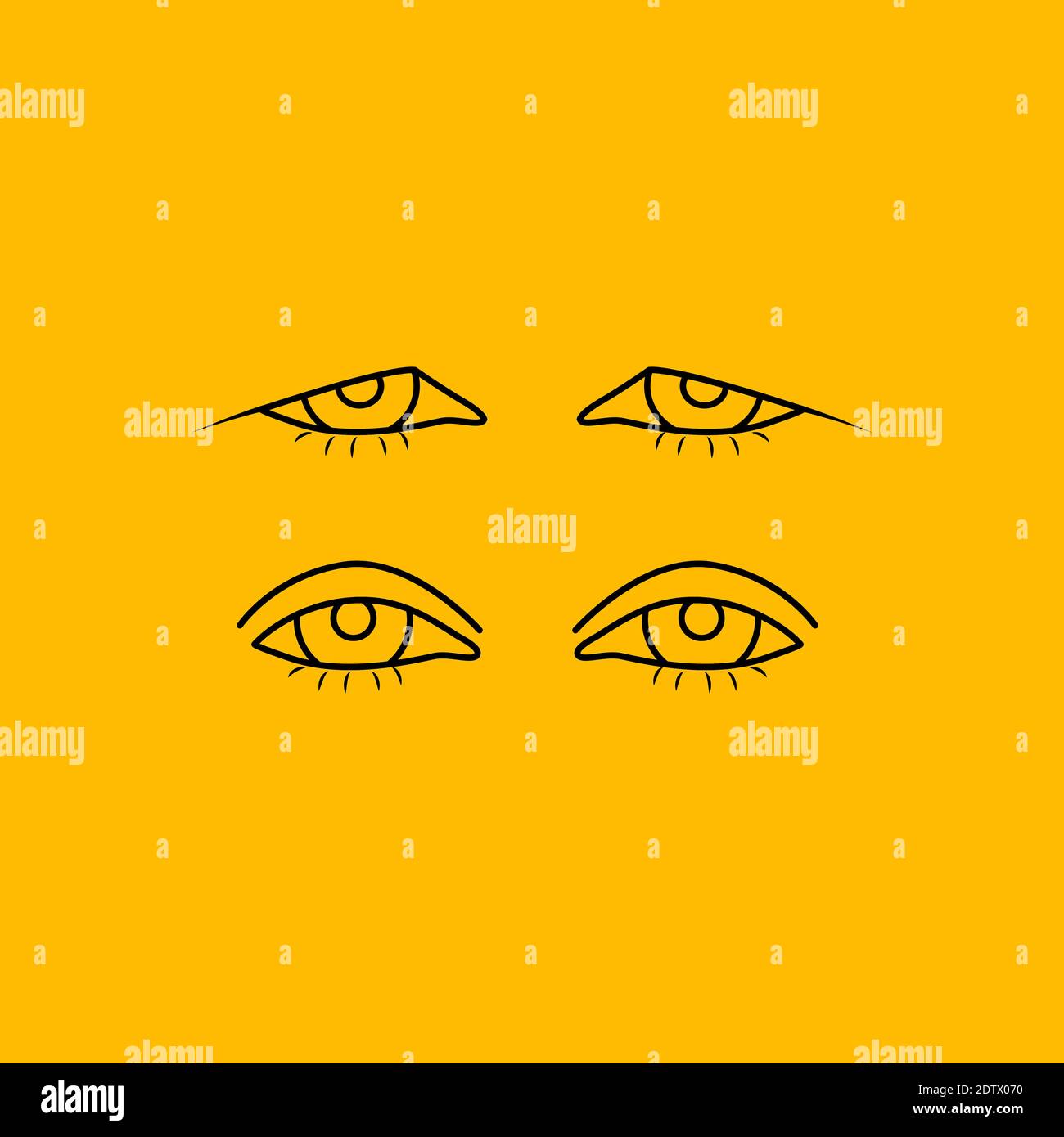 Upper eyelid blepharoplasty before and after, comparison Stock Vector