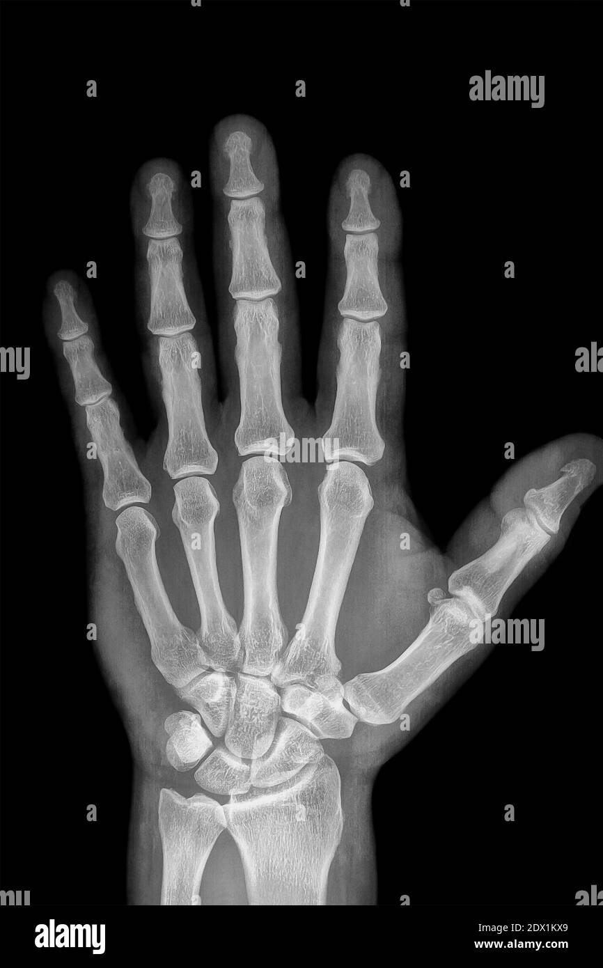 Hand Radiography of a hospital patient Stock Photo