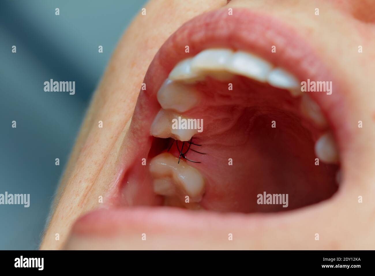 Closeup on suture after dental implant surgery Stock Photo Alamy