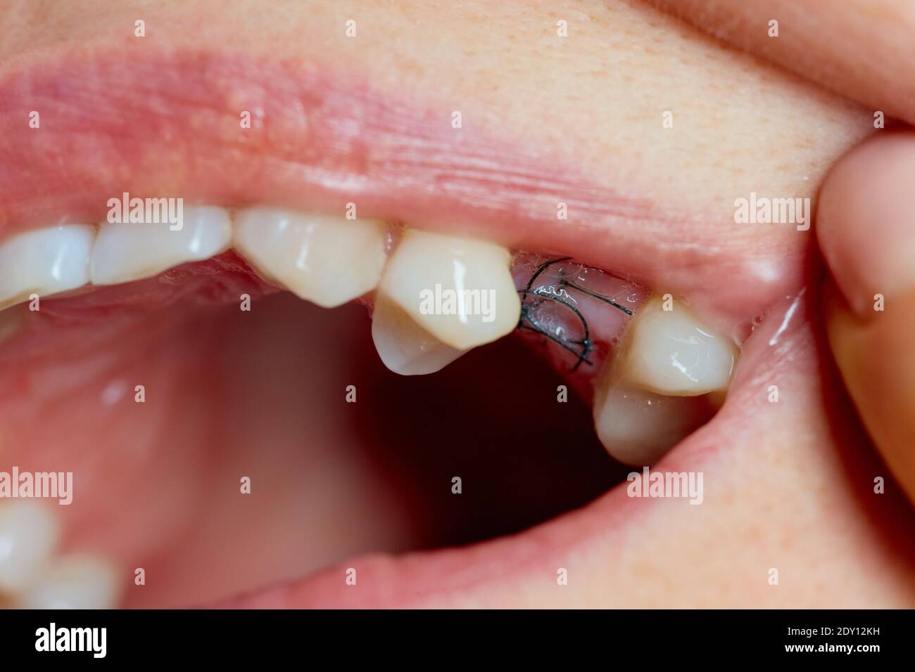 Closeup on suture after dental implant surgery Stock Photo Alamy