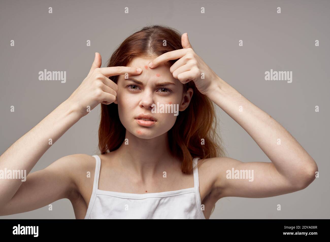 woman with loose hair pimples on face acne gesturing with hands  Stock Photo