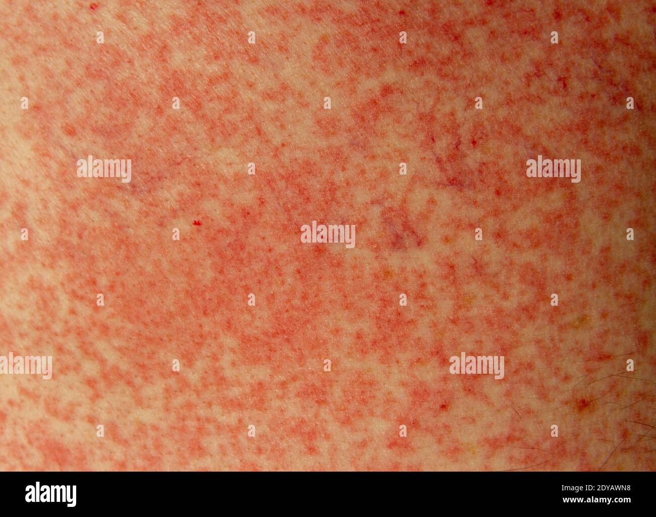 An allergic reaction (side effect) to penicillin (amoxicillin) on the skin of a 51 year old white man in London, UK. Stock Photo