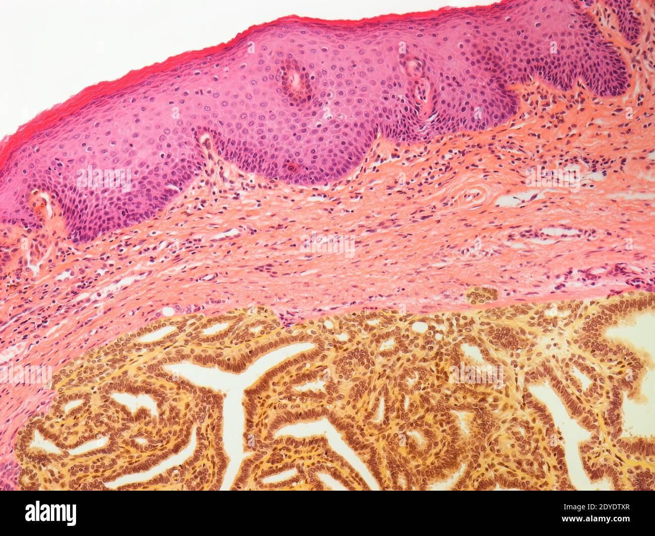Hidradenoma papilliferum, light micrograph (LM) of a section of affected vulva. Stock Photo