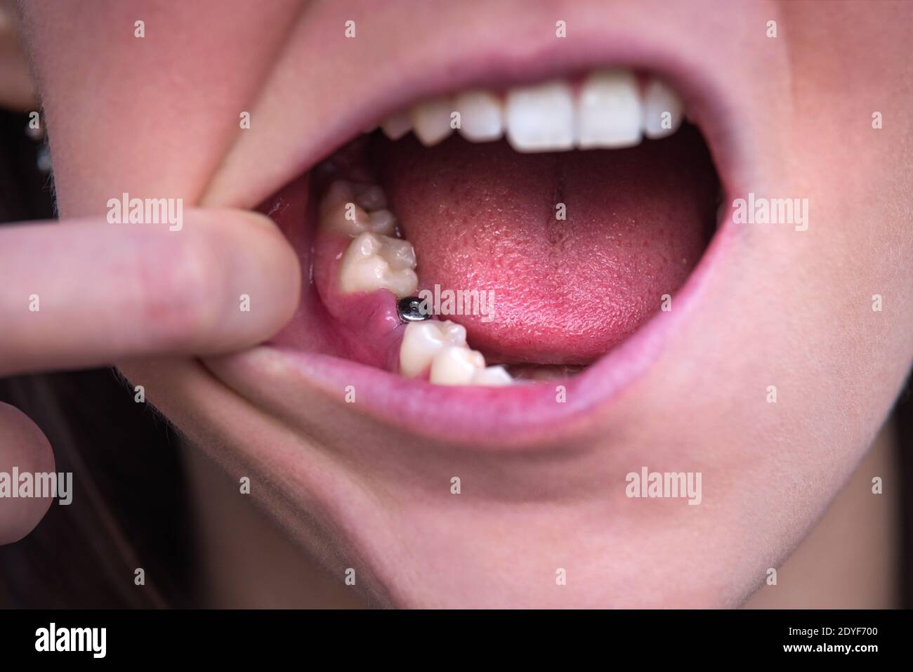 Single tooth implant. Missing tooth. Implant after tooth extraction Stock Photo