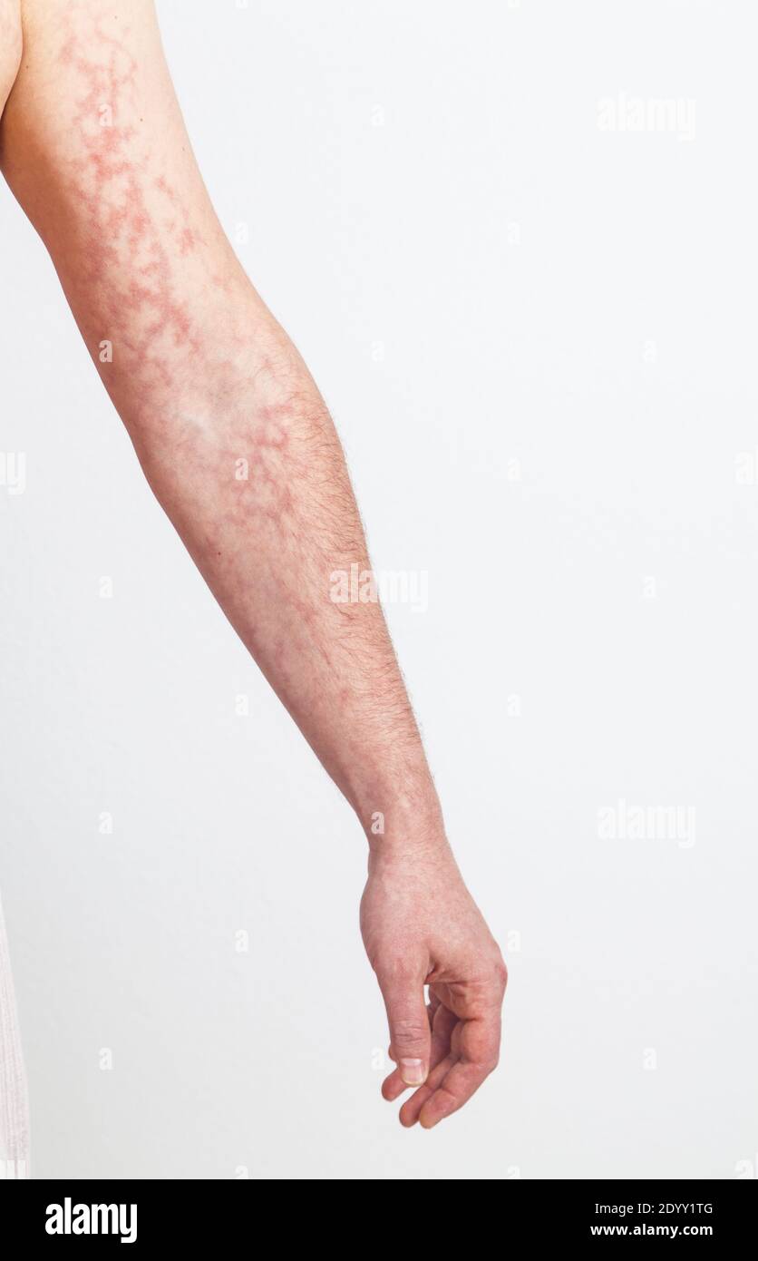 Male left arm with red skin capillary network Stock Photo
