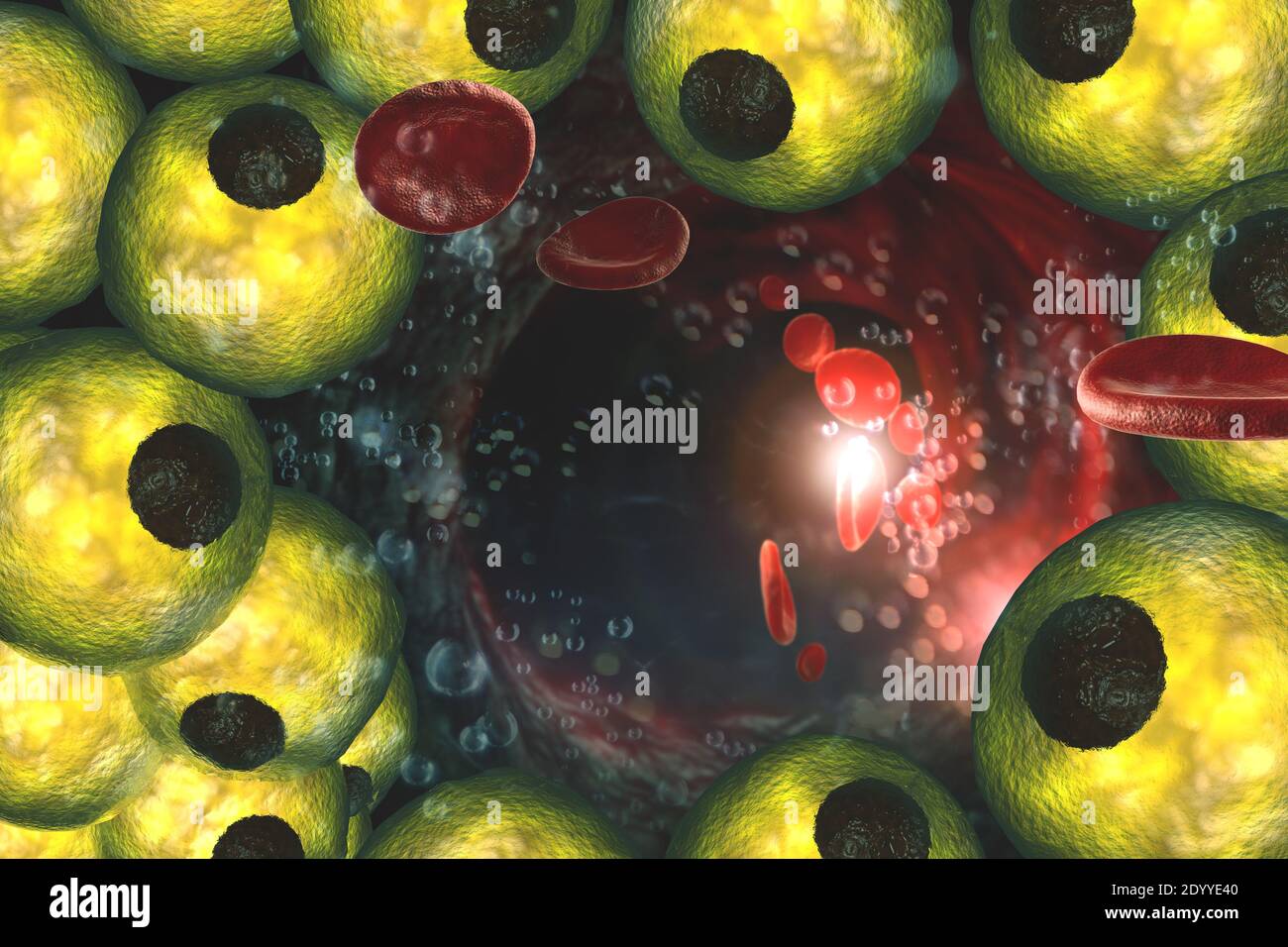Artery clogged with fat cell plaque build up which will lead to heart