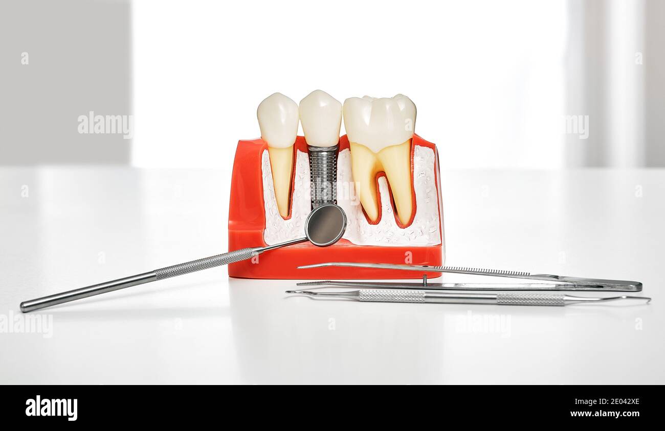 Dental prosthetics. Showing the installation of a dental implant on an