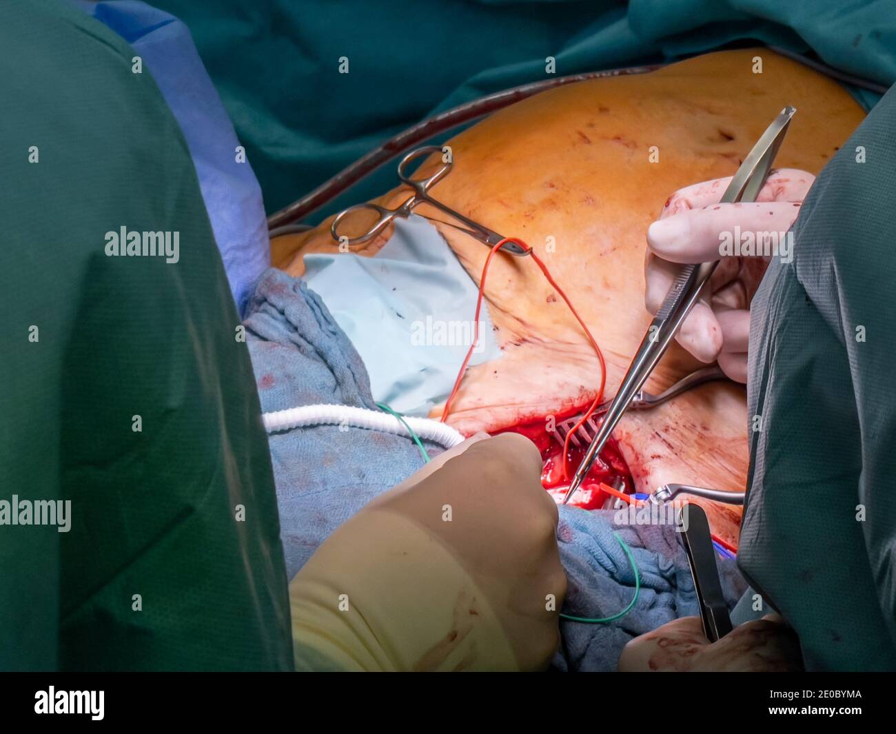 a vascular surgeon sews in an artificial tube prosthesis as a bypass for a blocked leg artery Stock Photo