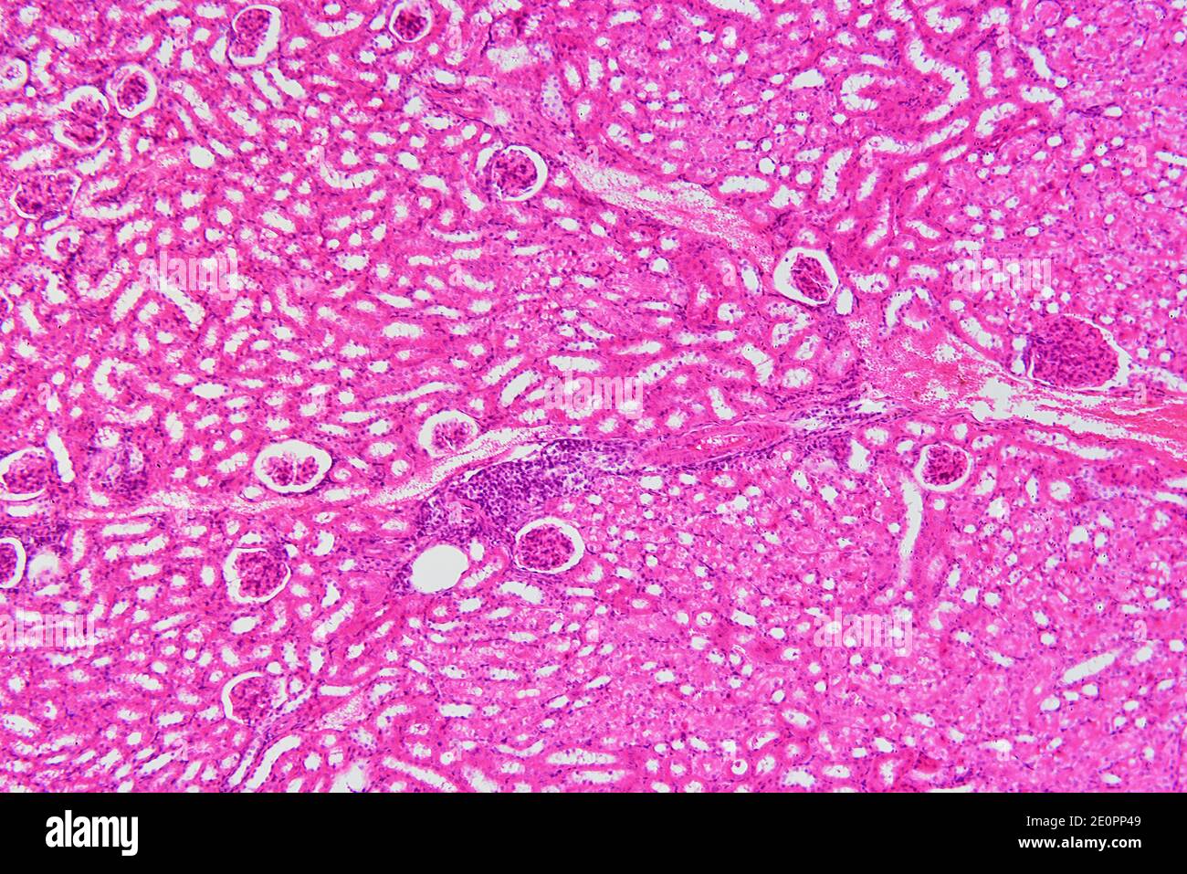 Human kidney section with injected blood showing glomeruli, Malpighian corpuscles and parenchyma. X75 at 10 cm wide. Stock Photo