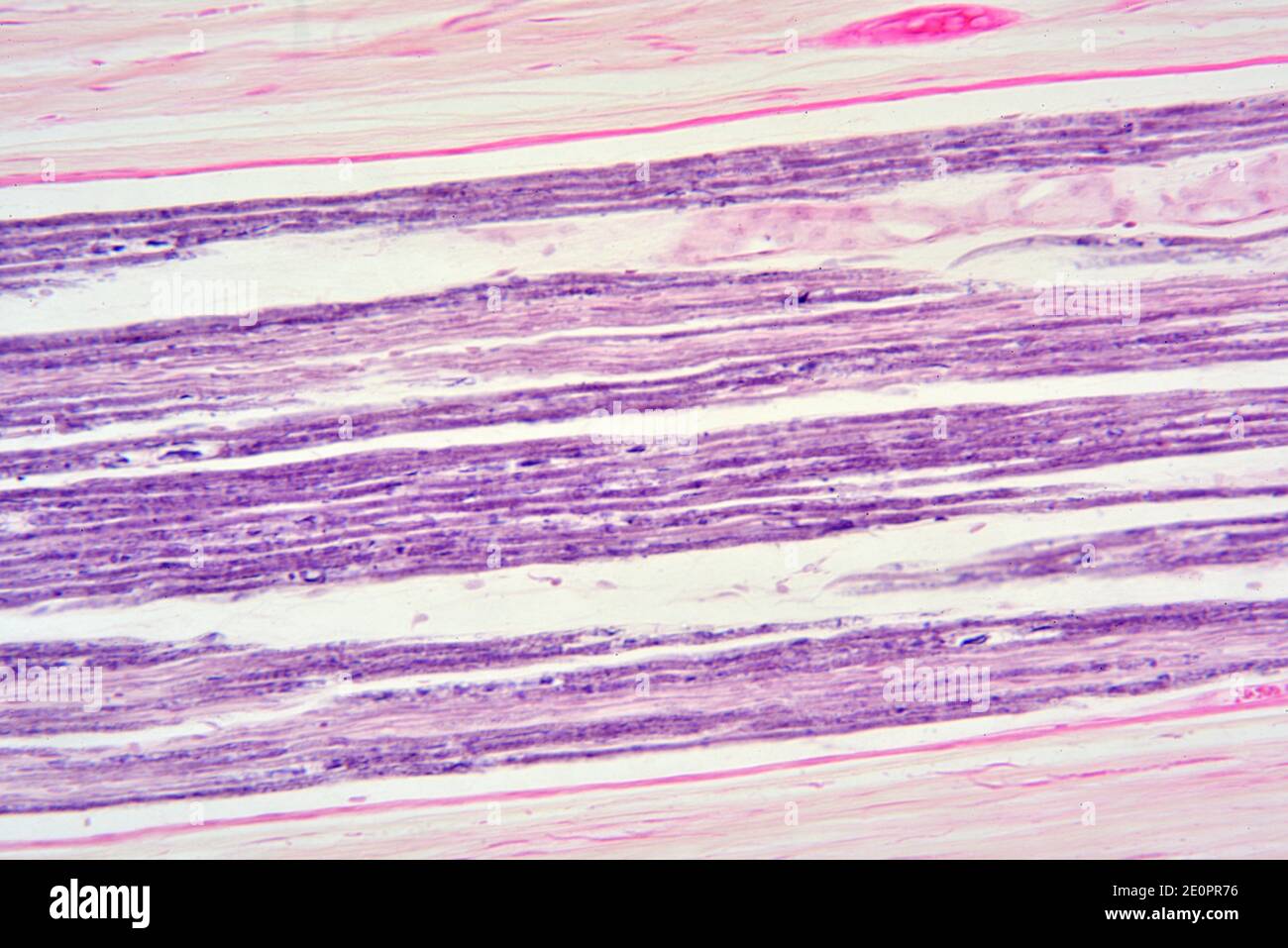 Human sciatic nerve or ischiadic nerve. X75 at 10 cm wide. Stock Photo