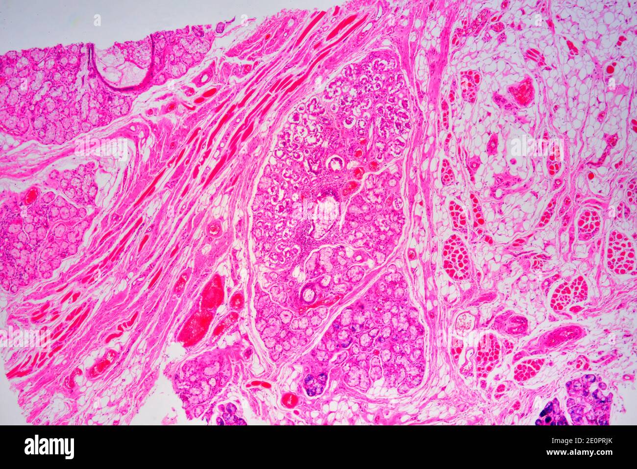 Parotid gland hires stock photography and images Alamy