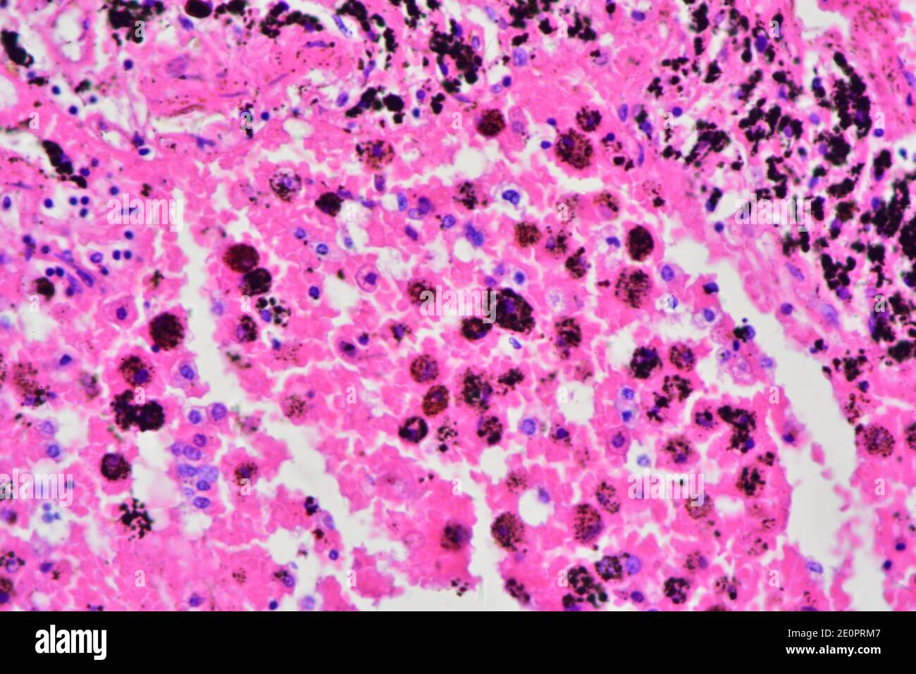 Human smoker's lung with carbon particles (black). Photomicrograph X300