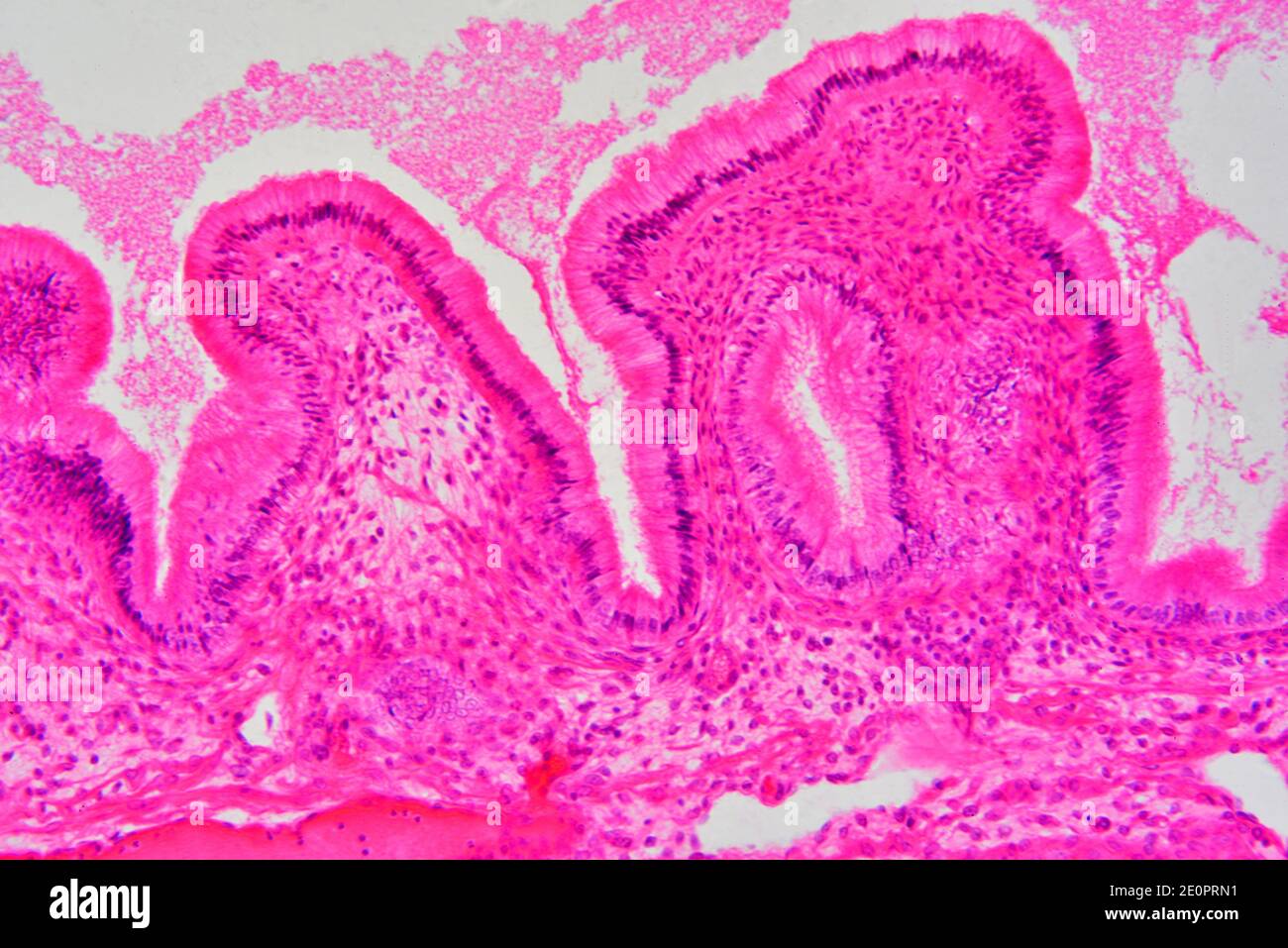 Gallbladder wall showing columnar epithelium with mucosal folds ...