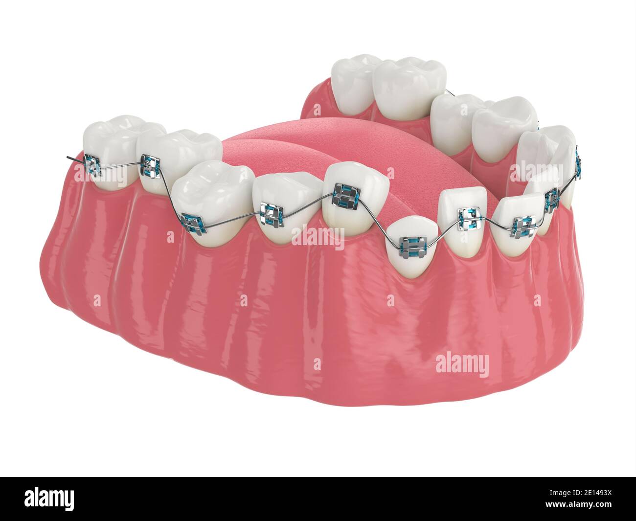 3d render of teeth alignment by orthodontic braces isolated over white