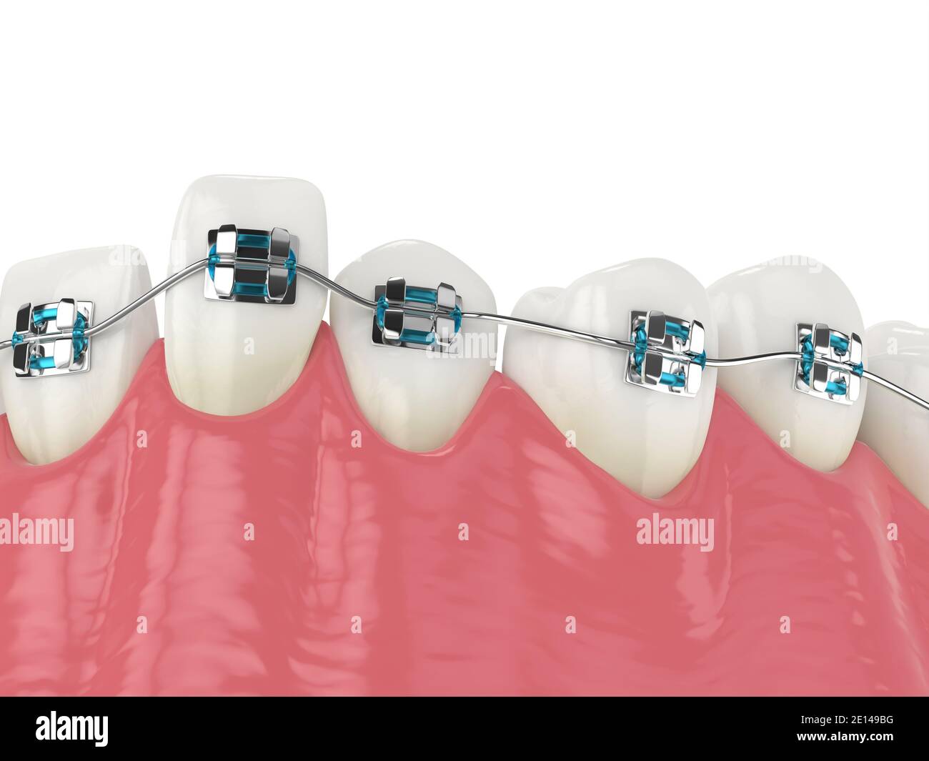 3d render of teeth alignment by orthodontic braces isolated over white