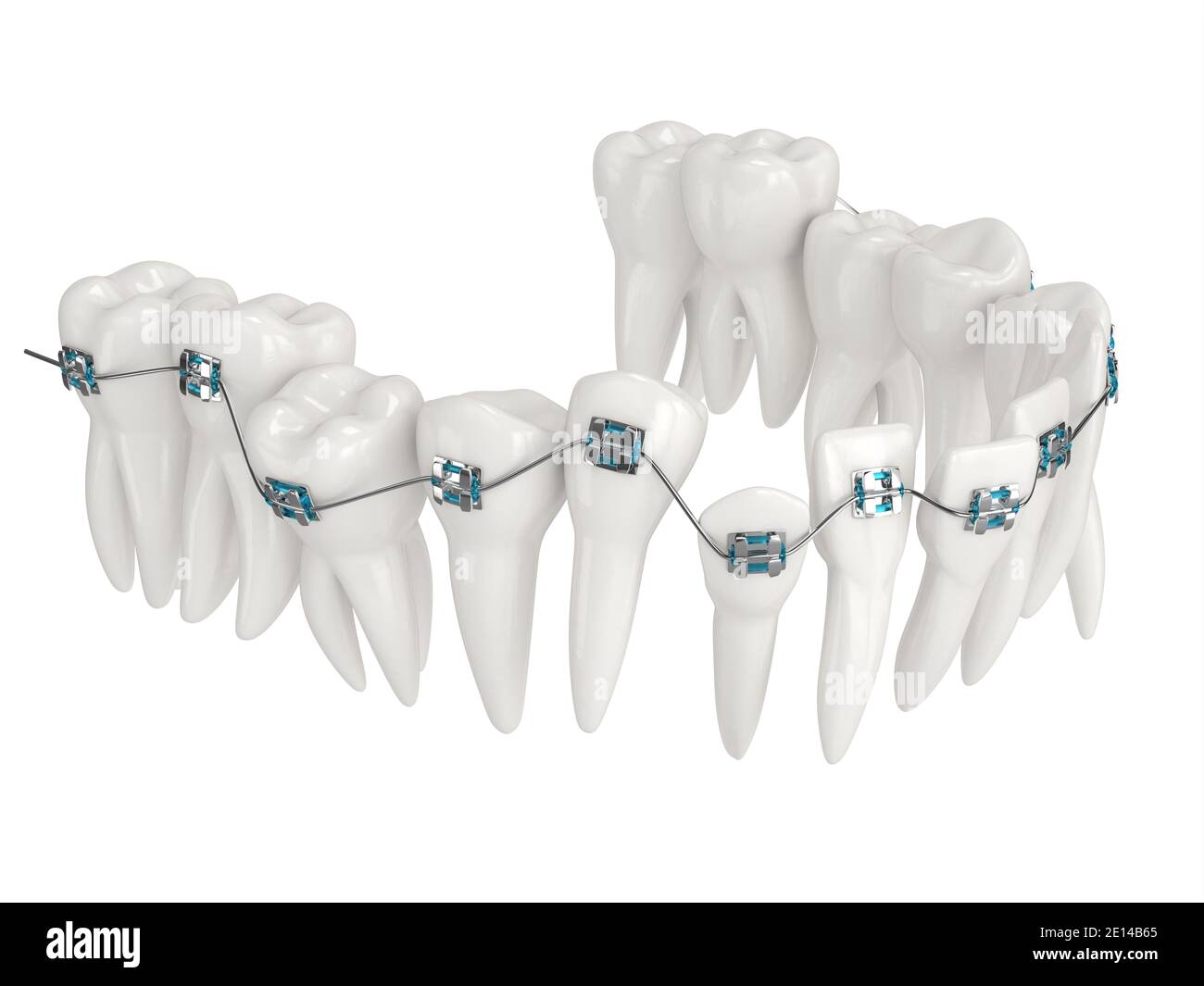 3d render of teeth alignment by orthodontic braces over white background Stock Photo