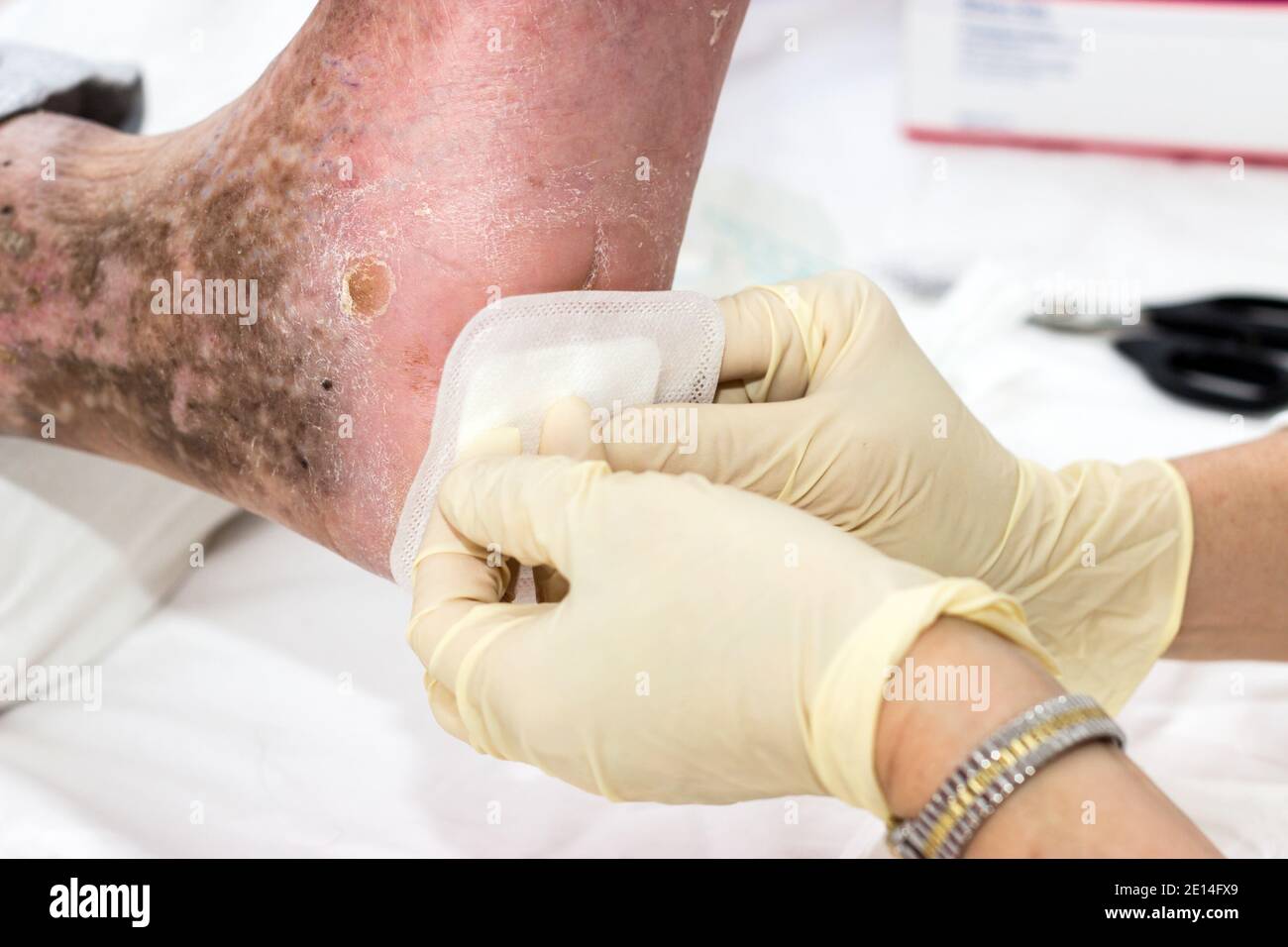 Diabetes Care With Wound Treatment Stock Photo Alamy