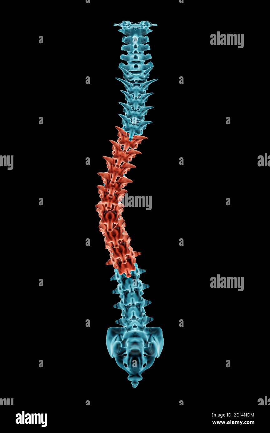X-ray spinal column with scoliosis and pathological vertebrae highlighted in red. Human curvature of the spine disorder 3D rendering illustration. Med Stock Photo