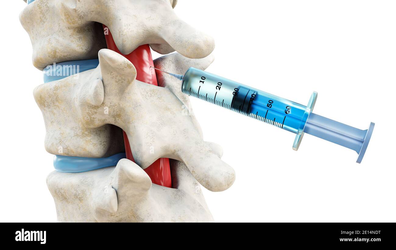 Syringe in the spinal cord isolated on a white background. Backbone or  spinal column treatment with epidural injection 3D rendering illustration.  Medi Stock Photo - Alamy