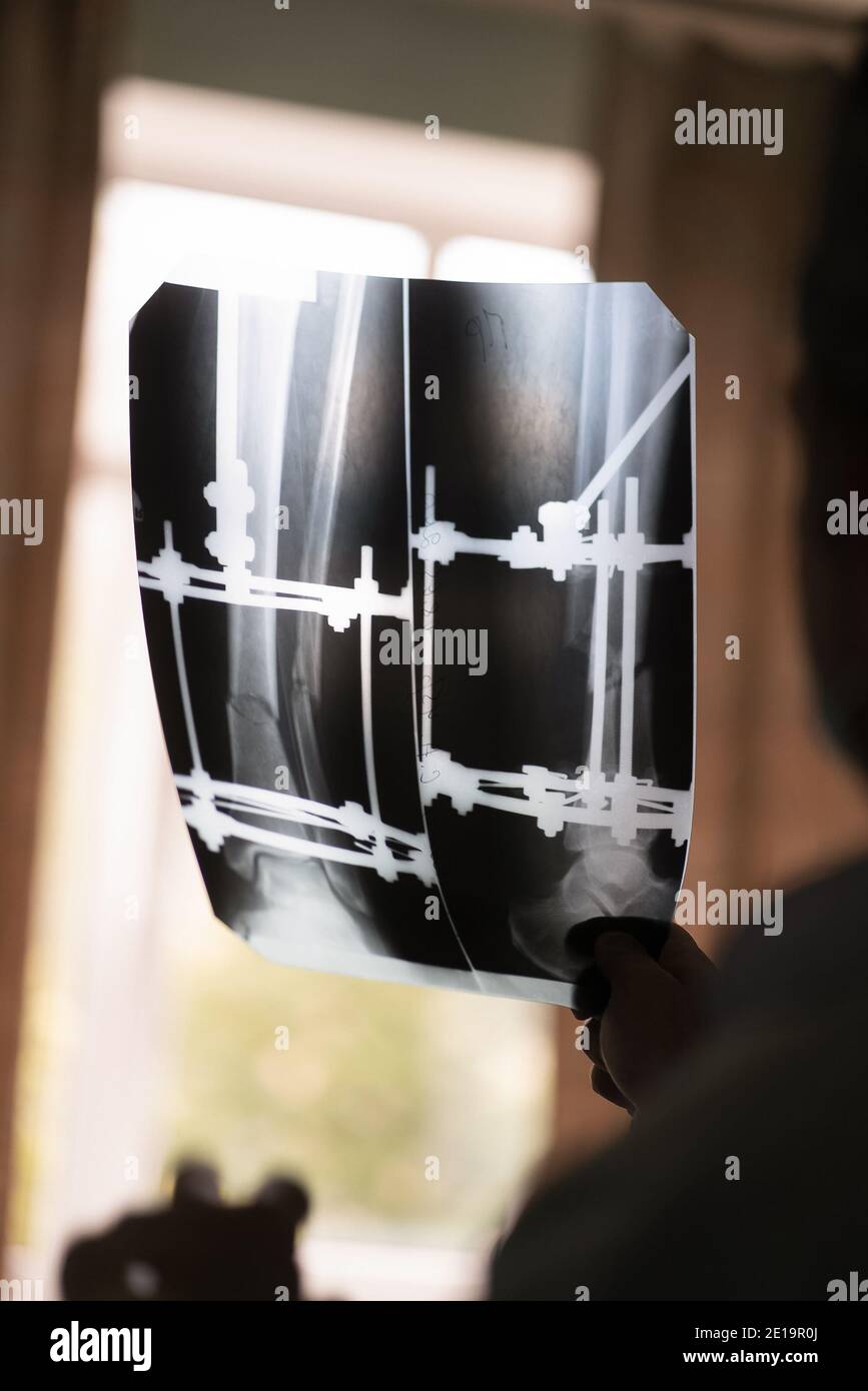 Close up of a x-ray in doctor hand checking on patient with Ilizarov apparatus fixation after orthopedic surgery. City Hospital, May 2020, Kyiv Stock Photo